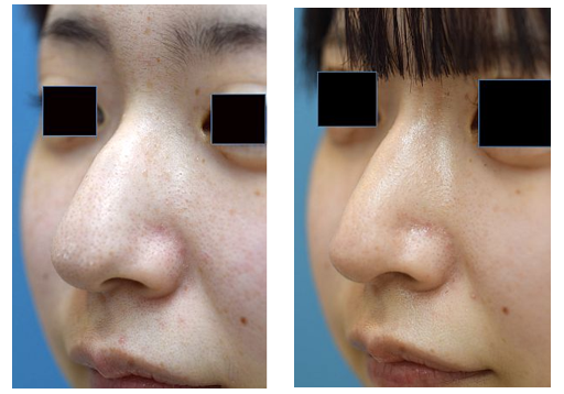 斜鼻修正THE ROPPONGI CLINIC ザロッポンギクリニック