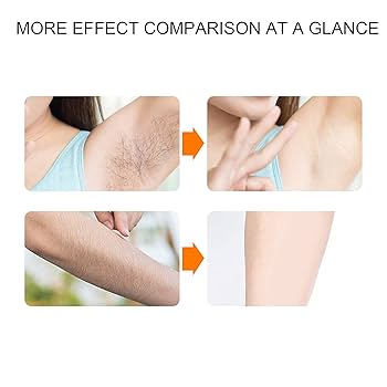 脇ビフォーアフター脱毛専門サロン Hily