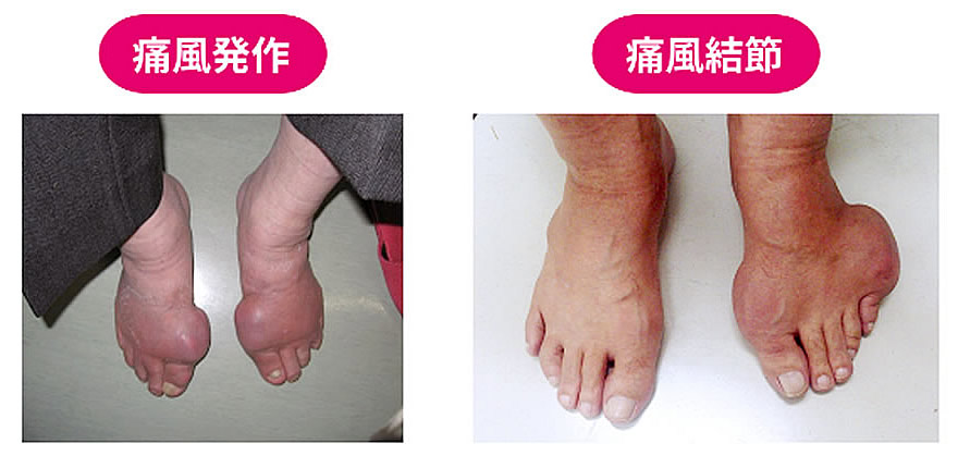 痛風の初期症状チェックシートどんな痛み？ピリピリを感じたら何科に行く？内科総合クリニック人形町