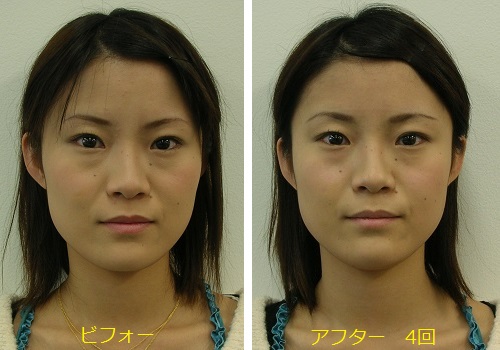 ホホ骨切り 頬骨形成 美容外科、美容整形の小木曽クリニック