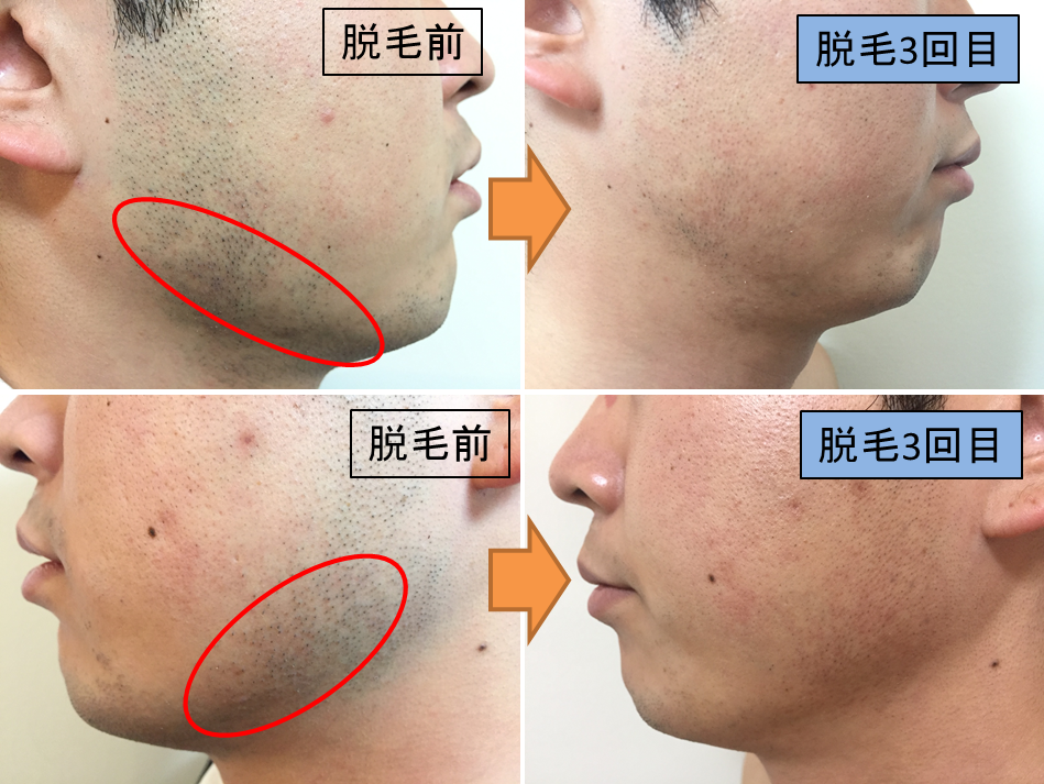 脱毛日記 4回目メンズ脱毛専門店 美men