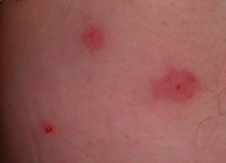 トコジラミ 南京虫 の刺し跡 画像あり の特徴とは？症状と対処法を解説！ トコジラミ駆除ならトータルクリーン