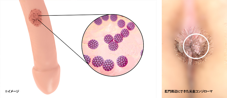 40代男性 コンジローマ除去・性病・包茎 - アモーレクリニック