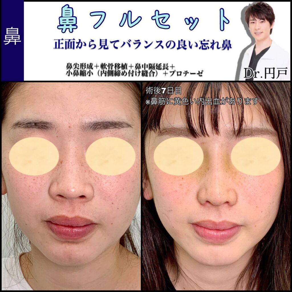 団子鼻・ぶた鼻・ニンニク鼻？あなたの鼻はどんなタイプ？医師が解説アールビューティークリニック 銀座・名古屋・大阪美容整形・美容外科・美容皮膚科