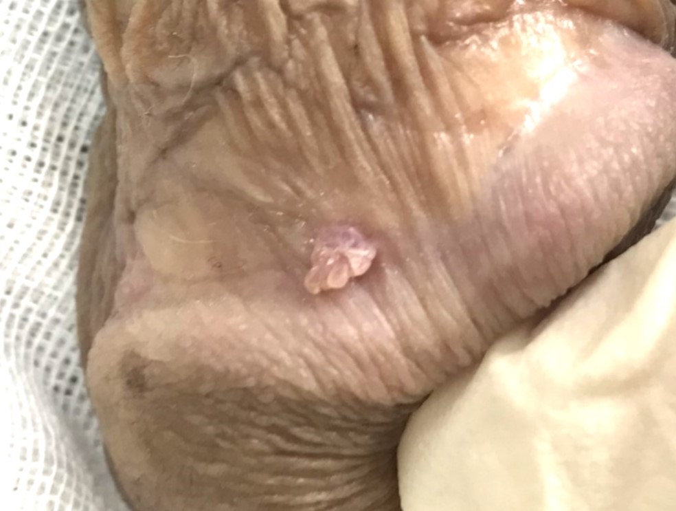 男性の尖圭コンジローマの症状・治療について – プライベートクリニック高田馬場 – 東京都新宿区