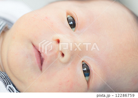 新生児黄疸についてペンギンこどもクリニック大府市小児科・アレルギー科