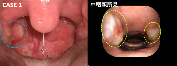 急性扁桃炎茨木市総持寺の小児科みやざきちびっこ診療所乳幼児健診・予防接種