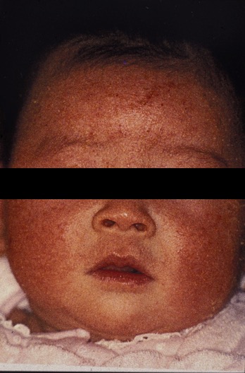 特に夏は注意！汗っかきな赤ちゃんの「あせも」予防と対策MIMI STAGE