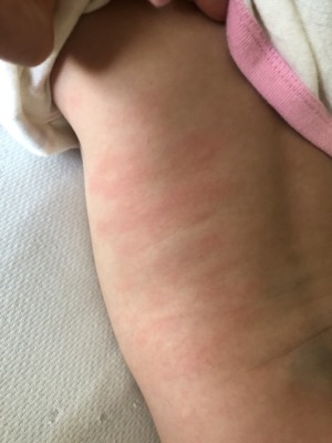 体の赤いポツポツについて 赤ちゃんの心と体 ベビーカレンダー専門家相談