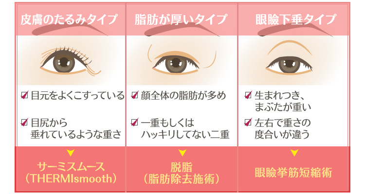 二重修正・眼瞼下垂の修正いちのせ形成外科眼瞼フェイスクリニック神戸大阪