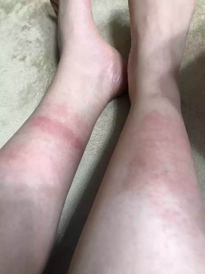 楽天市場第 2 類医薬品 アセムヒEX 15g セルフメディケーション税制対象ムヒ汗かぶれ かゆみ 赤み 湿疹 クリーム: 楽天24