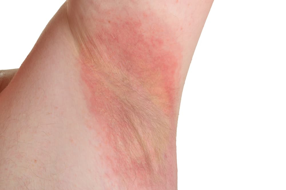 他的身體「紅一片」 濕疹癬、青春痘爬全身名醫趙昭明揭1狀況導致 祝你健康 三立新聞網HEALTH.SETN.COM