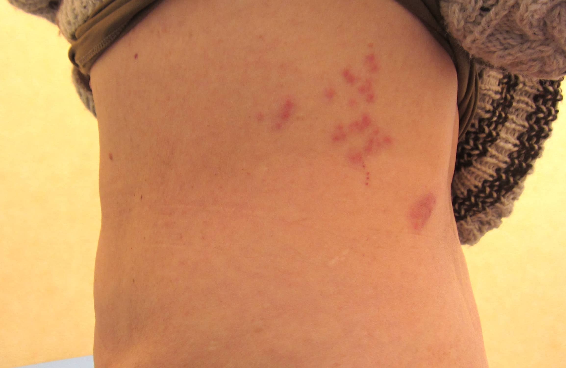 帯状疱疹 - 巣鴨千石皮ふ科