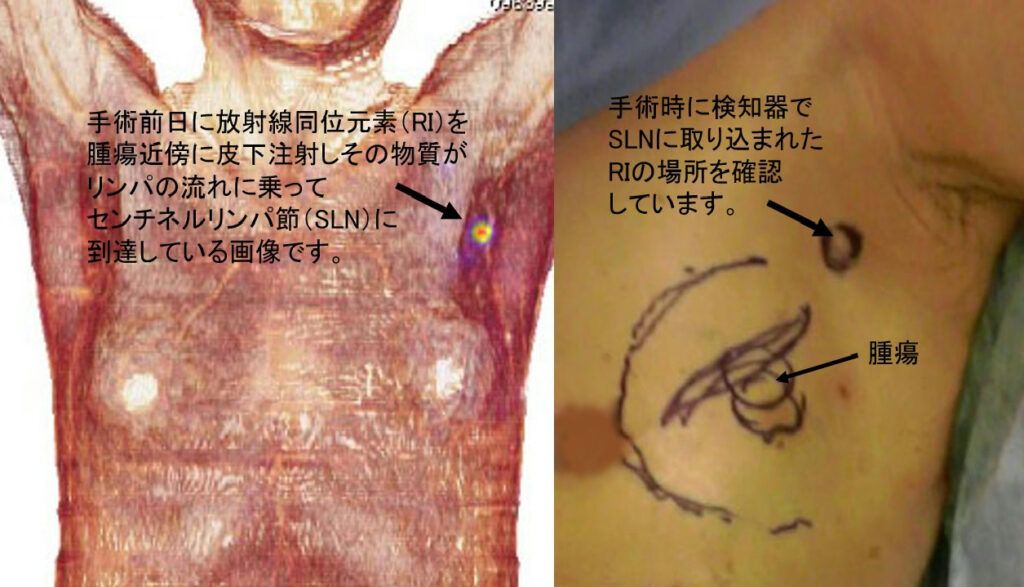 リンパ節腫大 - みやけ内科・循環器科 総合内科のアプローチ