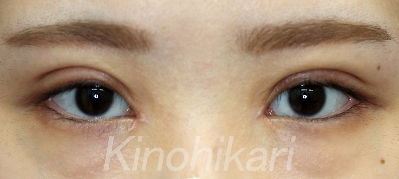 腫れぼったいまぶたルーフ切除脂肪切除脱脂ROOF二重まぶた