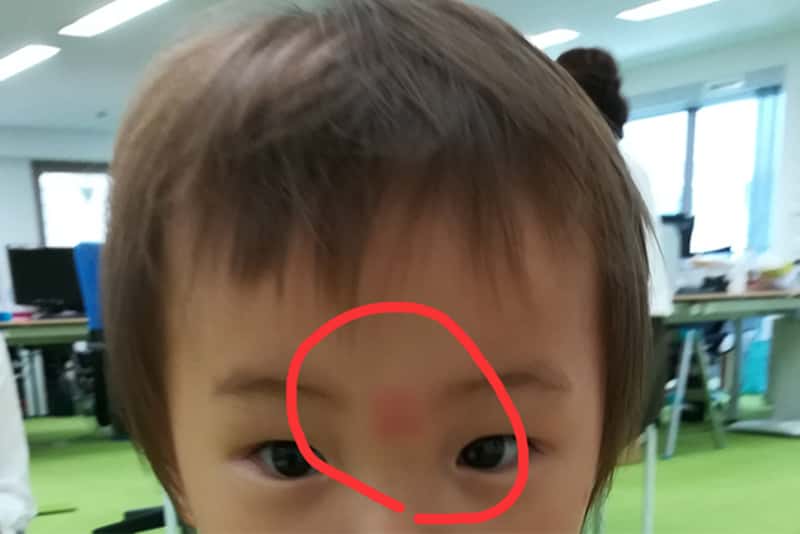 症例画像 虫刺されの症状・対処法 ひどい腫れや痒みも皮膚・爪・髪の病気All About