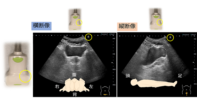 5.＜産科一般超音波検査・初期編＞ 正常所見4-7週 – 日本産婦人科医会