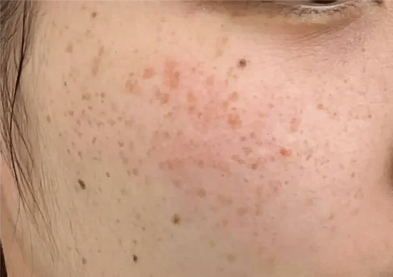 そばかすができるのはなぜ？治療で消すことはできるの？Shinagawa Beauty Navi