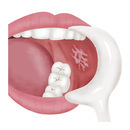 扁平苔癬による歯肉の発疹と腫れを歯周病治療で改善した症例木村歯科医院羽生市の痛くない歯科治療・予防歯科・審美歯科・インプラント