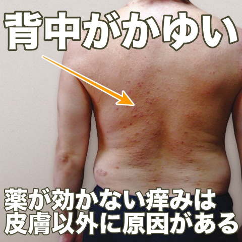 アトピー性皮膚炎とは？希望が丘やまぐち呼吸器内科・皮膚科クリニック