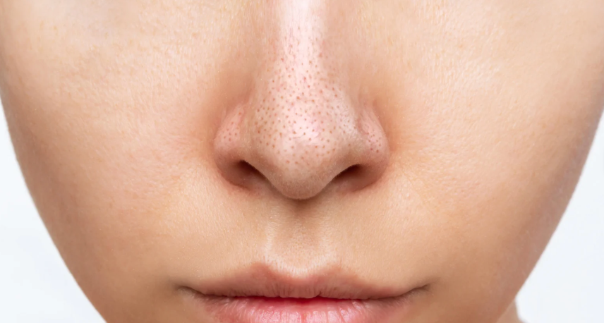 鼻の中のニキビはなぜできる？原因と対処法を解説！処方薬も紹介ANS. magazine