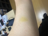 身に覚えのないあざが黄色い？考えられる原因と対処法を解説「さかぐち整骨院 -枚方市-」枚方市で口コミ評価NO.1