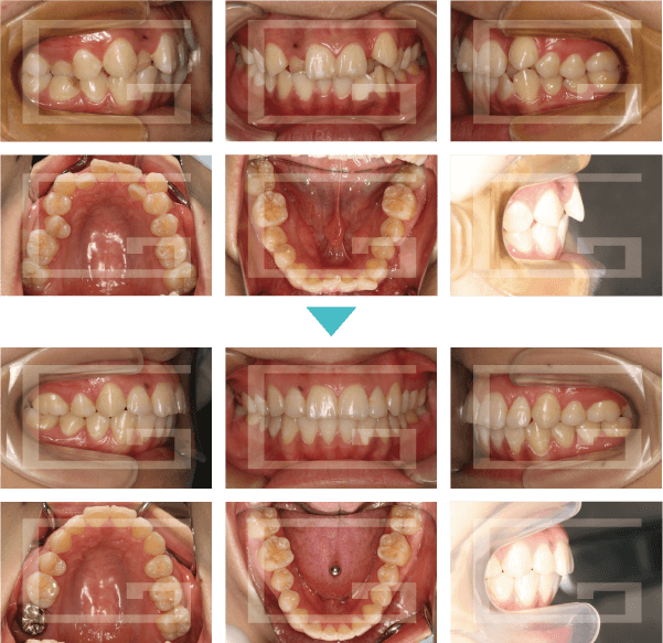 大人の歯列矯正 アラサーの大事な４年を捧げた歯並び改善の、その後＠BAILA