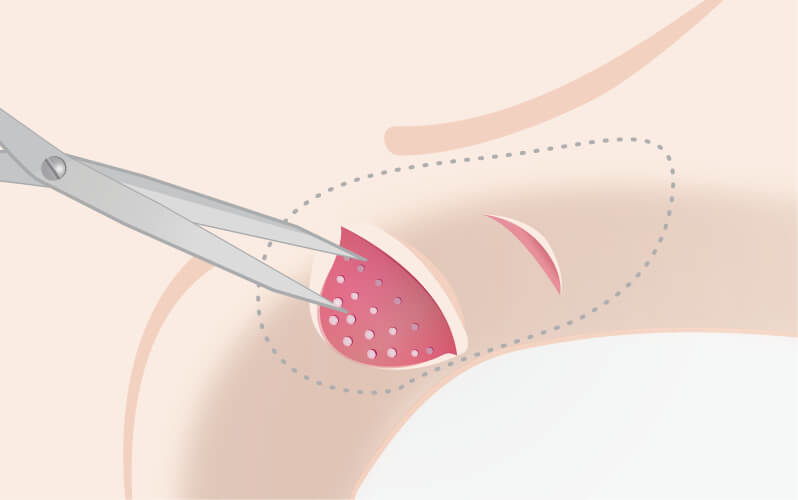ワキガとは？原因は？宇都宮市のたかだ形成外科クリニック