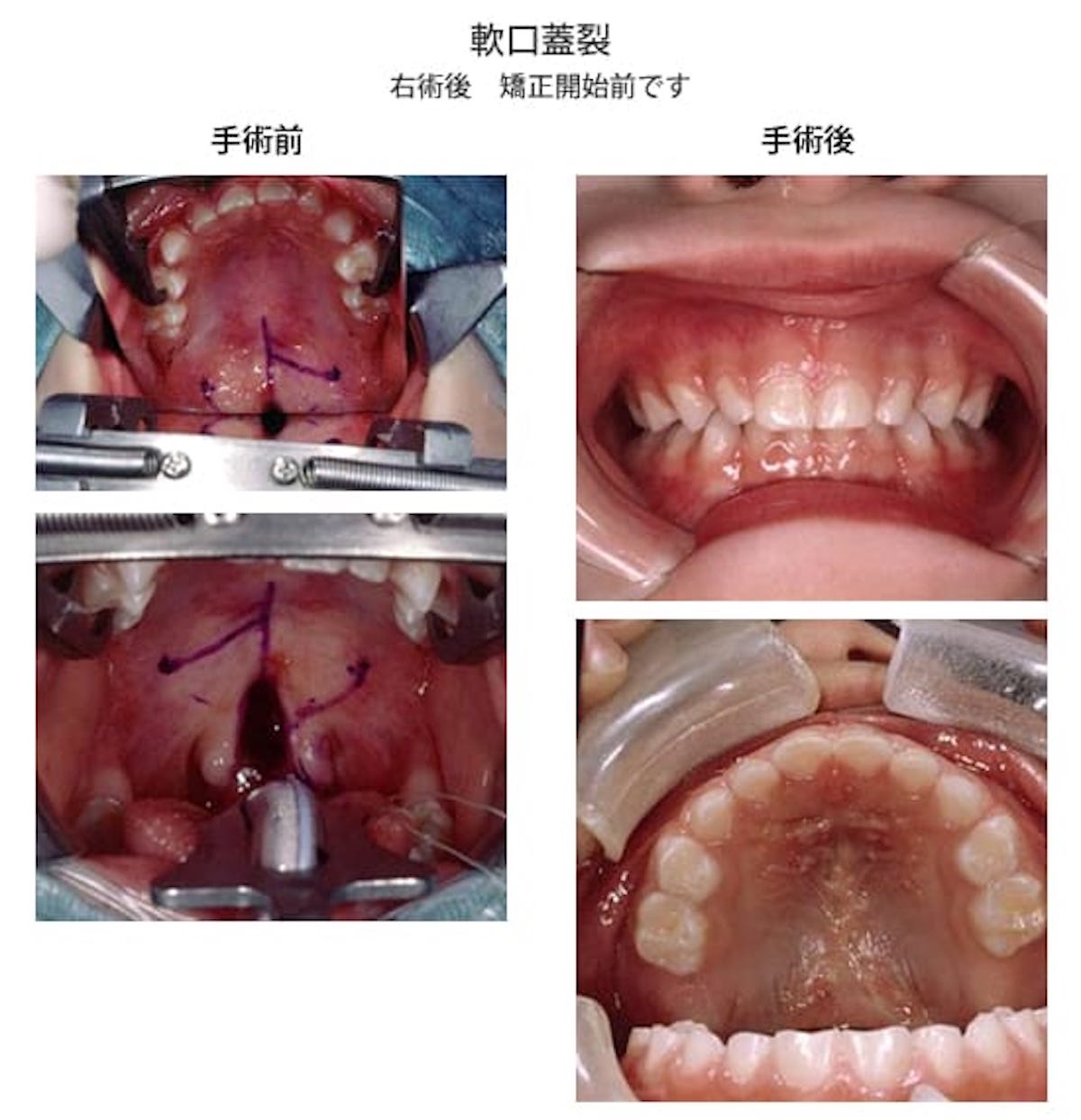 出産するまでわからなかった わが子が口唇口蓋裂で生まれて 体験談 たまひよ