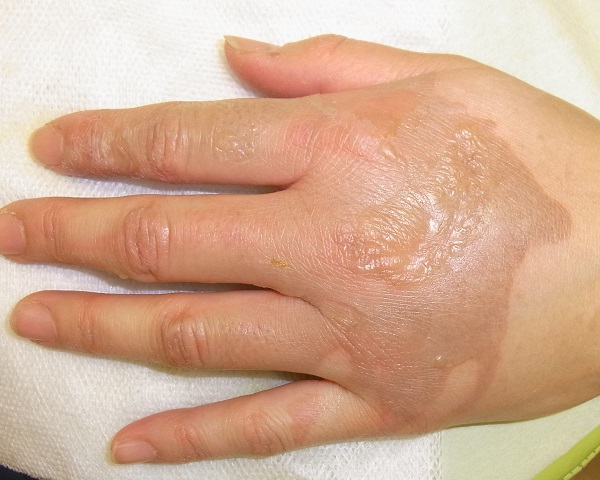 重症熱傷・火傷の治療法皮膚・爪・髪の病気All About