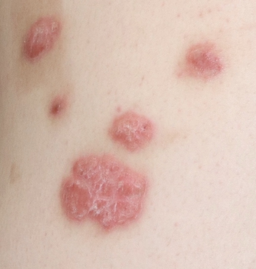 乾癬とは？ ただの乾燥肌だと見逃さず、乾癬を見分けるためのポイントあさ美皮フ科亀戸駅前