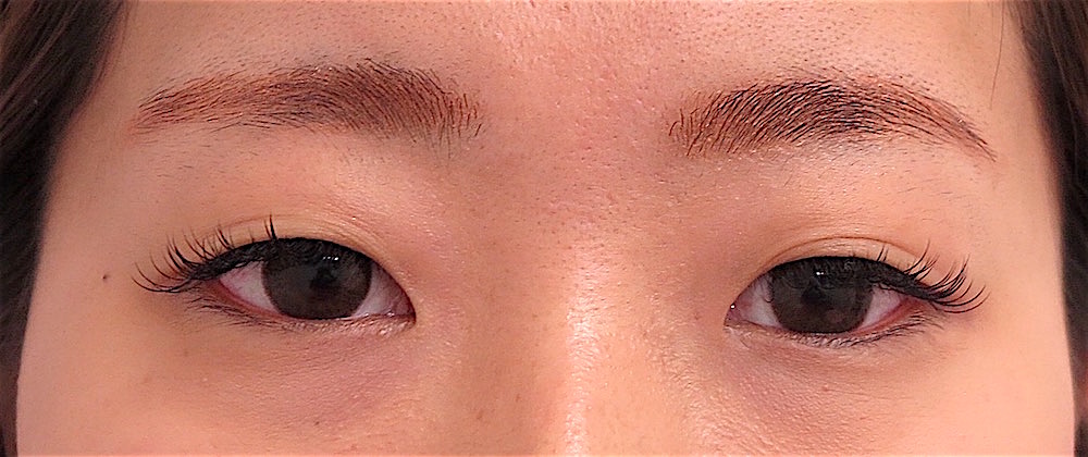 アイプチしすぎのかぶれには注意しましょう - 京都の美容外科・美容皮膚科医療法人京美会 烏丸御池ビューティークリニック