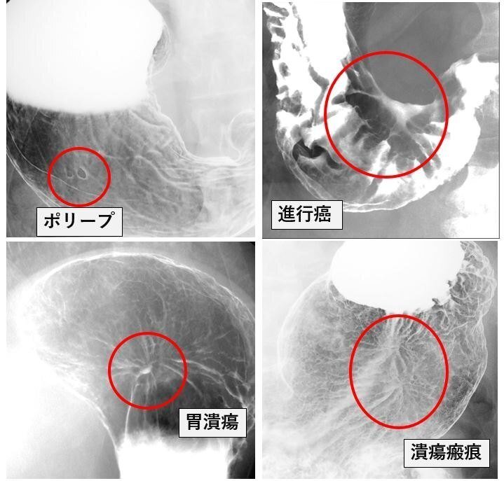 胃X線検査の撮影方法・画像の見方 - 第1種放射線取扱主任者試験対策