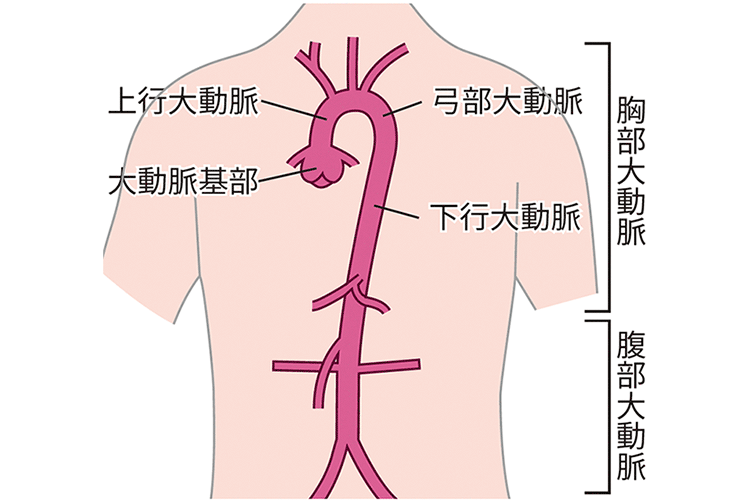 胸部大動脈瘤に対するハイブリッド手術病気と治療の検索サイト「メディカルブレイン」