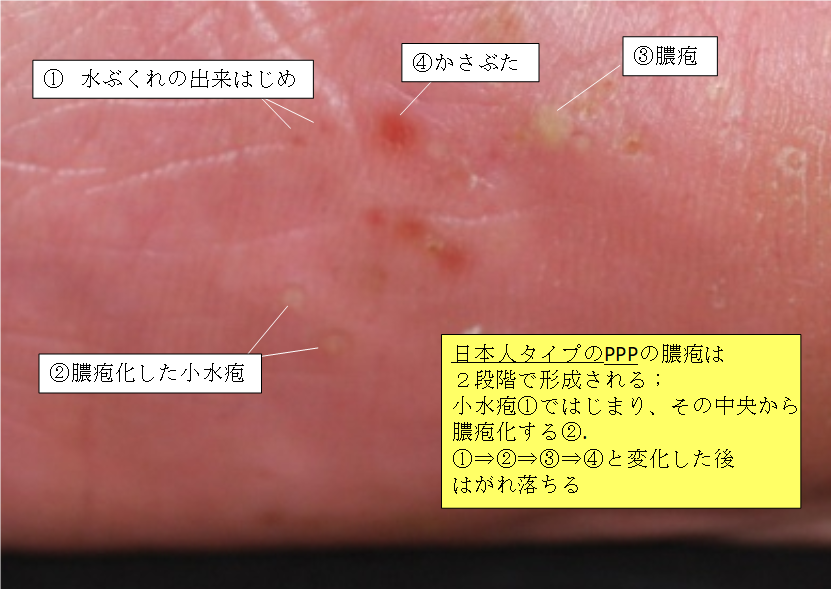 糖尿病とかゆみの関係は？皮膚に生じる主な症状や予防のポイントについて解説 - 府中すみよしクリニック