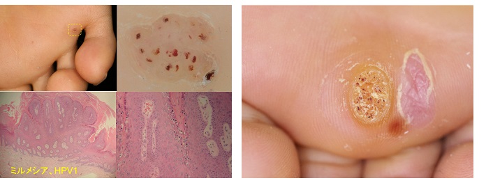 首イボの写真から、取れるイボと取れないイボをみてみよう - 首イボDr