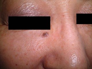 皮膚のできもの 皮膚がん・粉瘤・脂肪腫 分類、原因と特徴、治療を解説します！横浜市鶴見の形成・美容外科 エムズクリニック