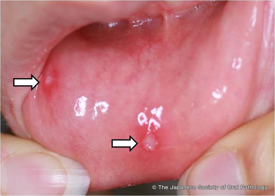 口唇ヘルペス仙台市青葉区歯科歯ぴか歯科