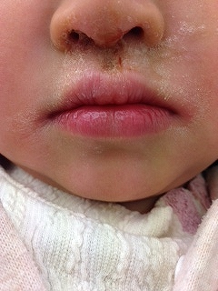 とびひ野田市 小児科 千葉県 こどもの花粉症 こどもの漢方 喘息 アトピー性皮膚炎 アレルギー 結節性痒疹 たんぽぽこどもクリニック