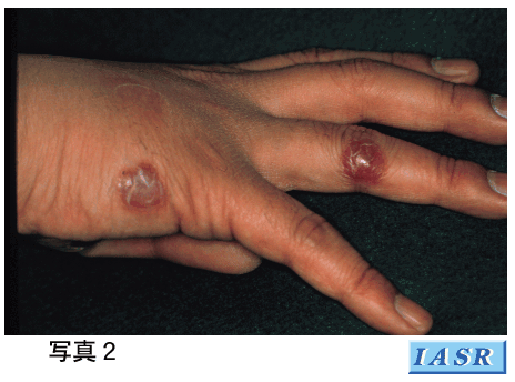 梅毒症状 写真 と感染経路・検査・治療池袋マイケアヒルズタワークリニック