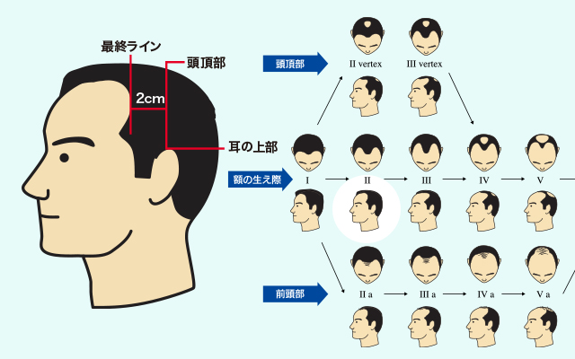 美容師が教える ハゲ隠しにオススメな髪型を薄毛タイプ別に徹底解説！│CAXヘアケア情報サイト