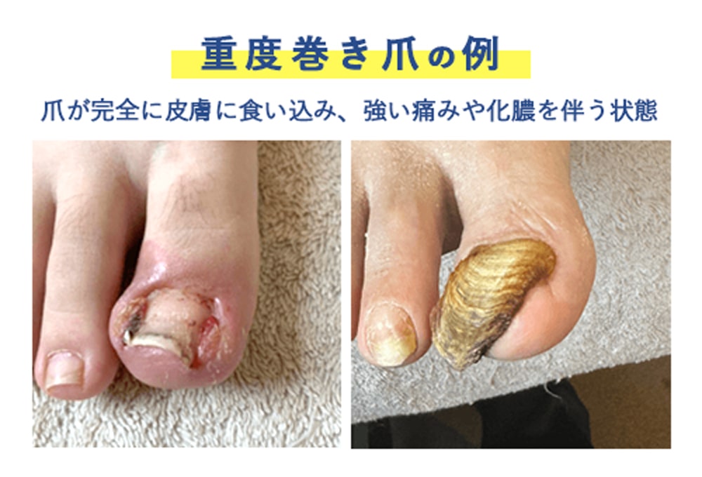 巻き爪・陥入爪 かんにゅうそう にならないための爪の切り方 – 横浜能見台巻き爪センタ