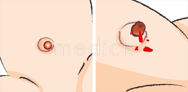 臍炎・臍肉芽腫とはの説明スライド - 医療のイラスト・写真・動画、素材販売サイトのメディック medick
