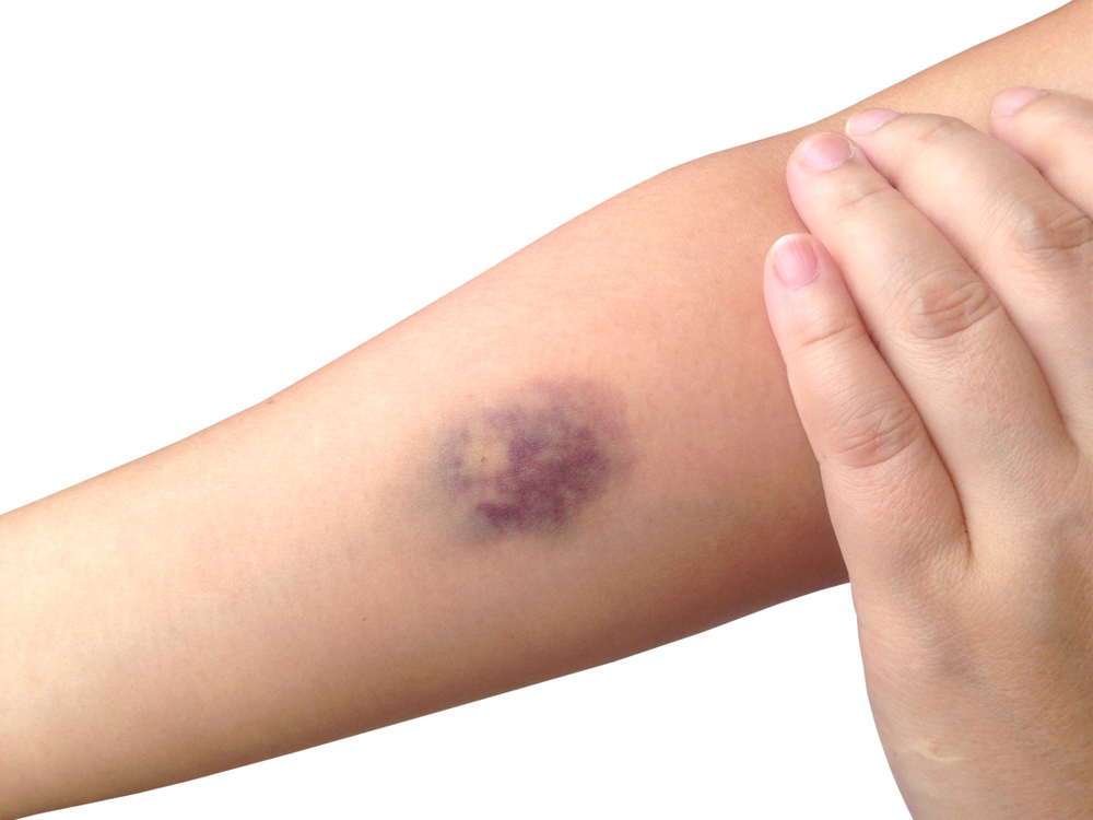 あざ箕面・茨木・池田の皮膚科・美容皮膚科みのお花ふさ皮ふ科・美容皮膚科