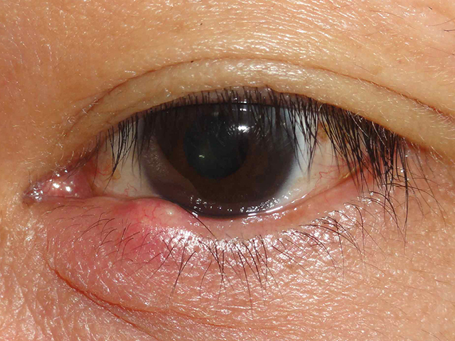 あいのり桃さん、次男の眼が大変なことに 真っ赤に腫れあがり「めちゃくちゃ痛々しい ！！」 - ECナビ