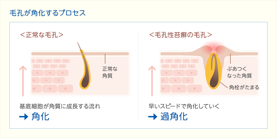 アトピー性皮膚炎の症状・原因とは？入浴・保湿時のスキンケア肌トラブルとスキンケア持田ヘルスケア株式会社