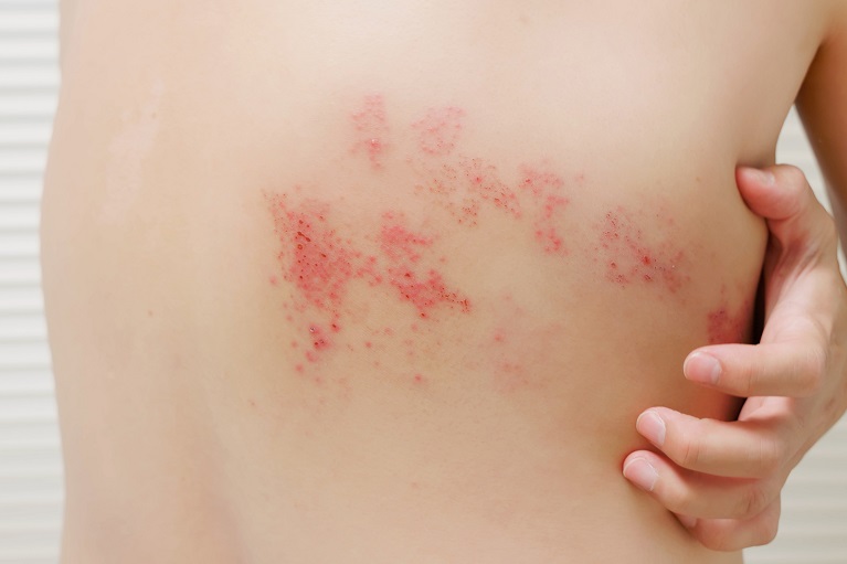 糖尿病早期水疱的图片