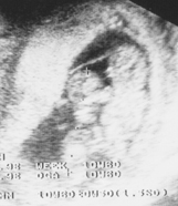 1絨毛膜1羊膜双胎 MM双胎MMtwins