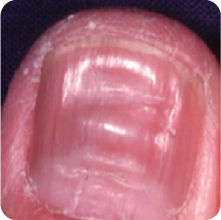 画像あり 爪の病気一覧・主な病気の症例画像皮膚・爪・髪の病気All About