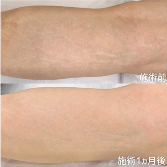 一度できてしまったらもう消えない？ 『肉割れ』ができる原因と対策を徹底リサーチ！マキアオンライン美容雑誌『MAQUIA マキア 』公式ビューティサイト